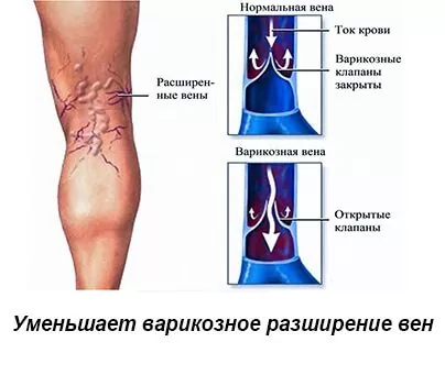 Уменьшает варикозное разширенее вен